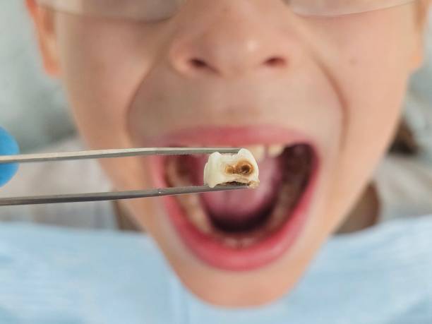 Best Knocked-Out Tooth (Avulsed Tooth) Treatment in Richmond Hill, GA